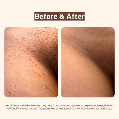 Bikini Line Aftercare Serum